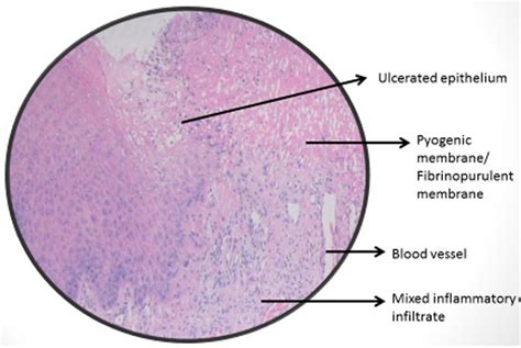 Photomicrograph of pyogenic granuloma | Download Scientific Diagram