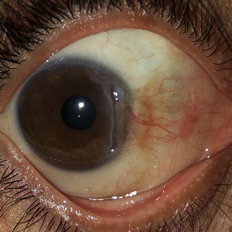 Peripheral corneal ulceration - American Academy of Ophthalmology