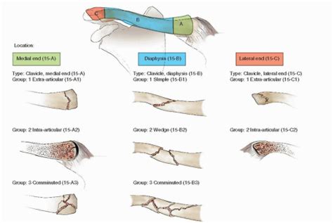 Classification Of Clavicle Fracture