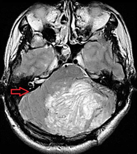 Lhermitte-Duclos disease - wikidoc