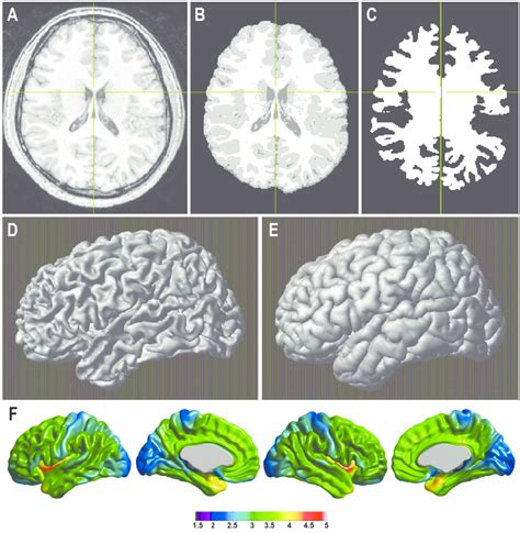 An outline of the cortical thickness measurement pipeline. (A) data are ...