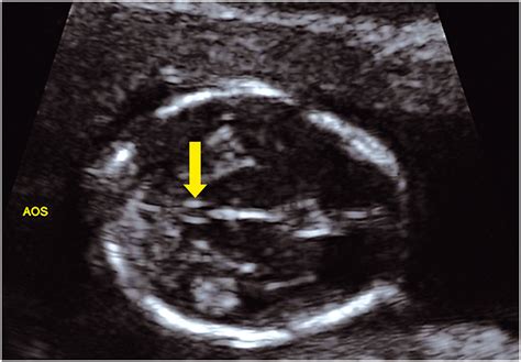 Spina Bifida Ultrasound