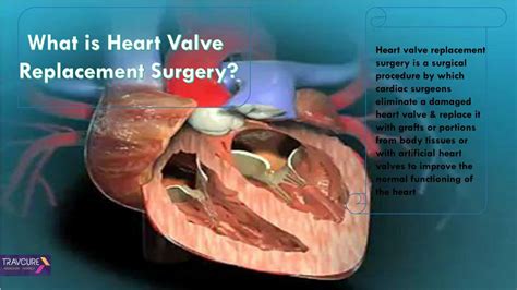 PPT - Heart Valve Replacement Surgery Procedure PowerPoint Presentation ...