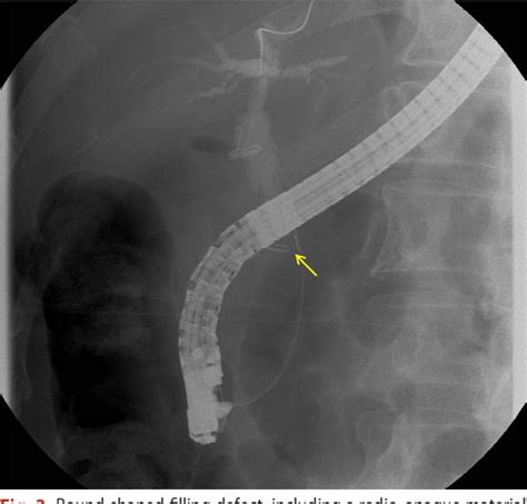 Figure 1 from Common Bile Duct Stone Caused by Migrated Surgical Clip ...