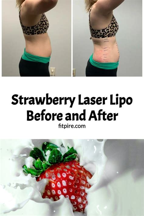 Strawberry Laser Lipo Before and After | Laser lipo, Lipo before and ...