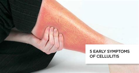 5 Early Symptoms of Cellulitis : Causes, Treatment and Faq's