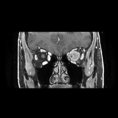 Radiology Cases: Optic nerve Meningioma