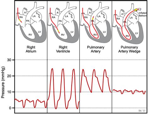 CV Physiology | Pulmonary Capillary Wedge Pressure