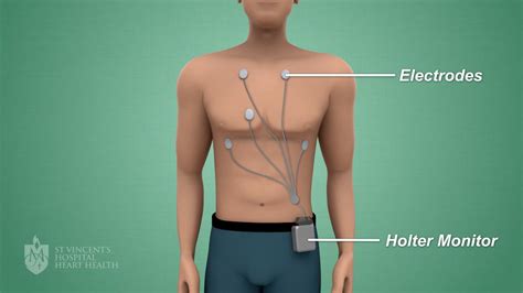 Holter Monitor 5 Lead Placement Diagram - Wiring Diagram