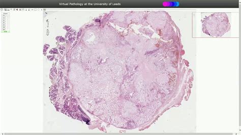 Pleomorphic Adenoma - Histopathology - YouTube