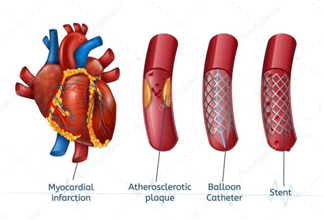 Infarto miocardico. 3d Realostic Stent nel cuore Stock Vector by ...