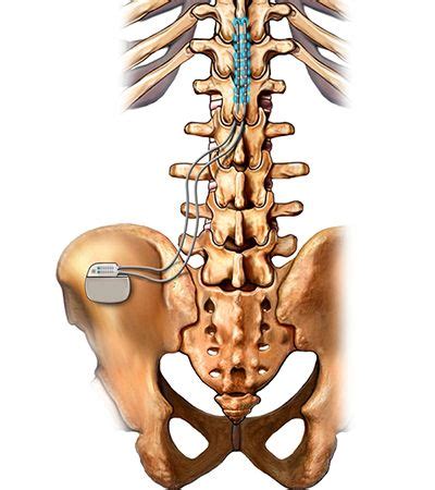 Spinal Cord Stimulator in NJ | Pain Management Doctor, Specialist