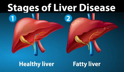 11 Best Foods to Treat Fatty Liver Naturally - Getinfopedia.com