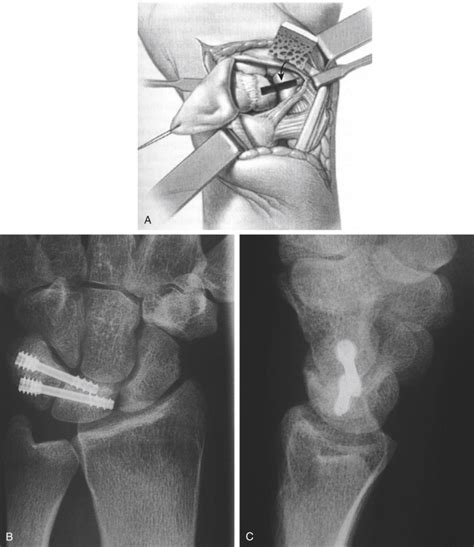 Lunotriquetral Ligament Instability/Tear: Acute and Chronic ...