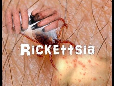 Rickettsia - YouTube