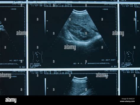 abdominal ultrasound scan Stock Photo - Alamy