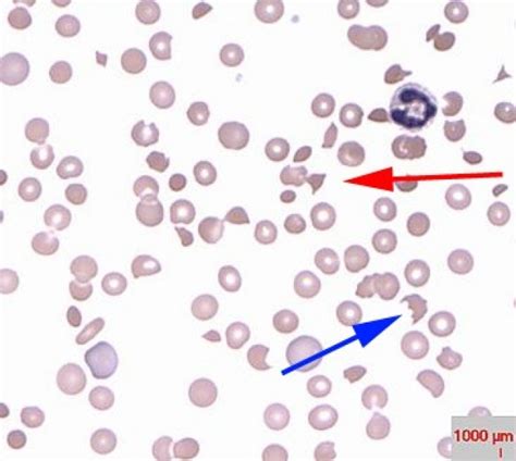 What is the Howell-Jolly body? | Stanford Medicine 25 | Stanford Medicine