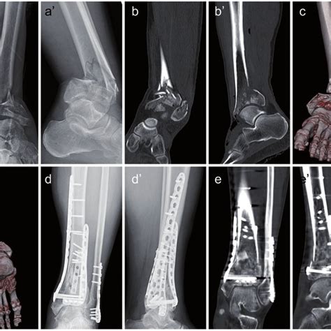 Schematic layout of four-column classification of tibial plafond. (a)... | Download Scientific ...