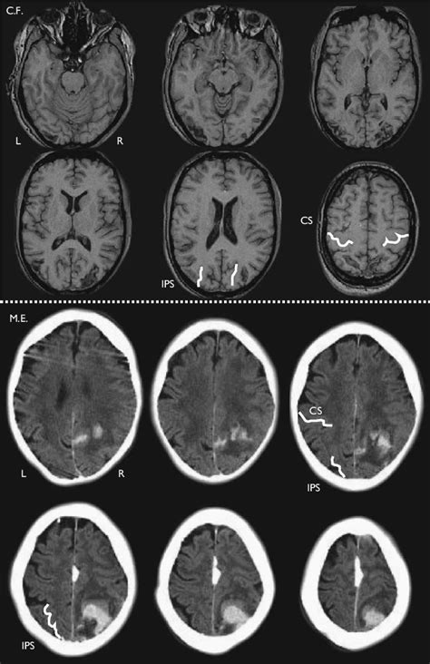 Upper panel: T1 MRI of C.F. 's bilateral lesions to superior parietal... | Download Scientific ...