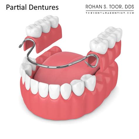 Partial Dentures: Process, Problems, Time it takes, Types, Lifespan ...