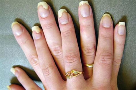 7 Symptoms To Spot The Nail Fungus Before it Harms