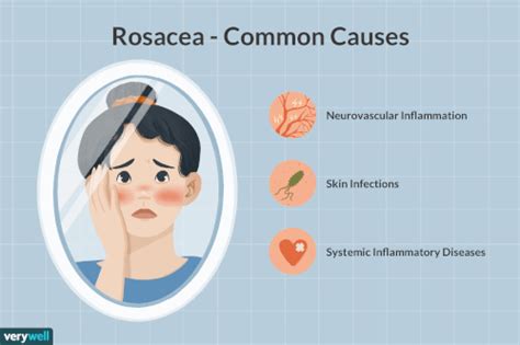 Rosacea: Causes and Risk Factors