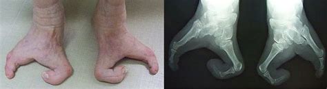 Foot Care in Michigan: What is "Lobster-Claw Syndrome?"