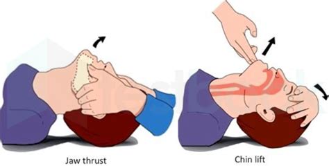 [Solved] Airway maneuver to open airway recommended in trauma patient