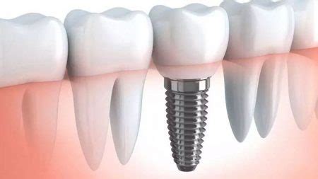 Titanium Dental Implants – What You Need to Know – Entirely Health