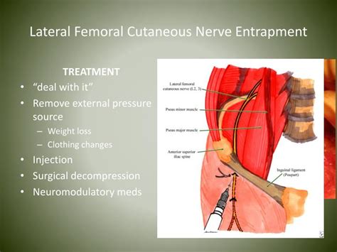 Anterior Femoral Cutaneous Nerve Entrapment