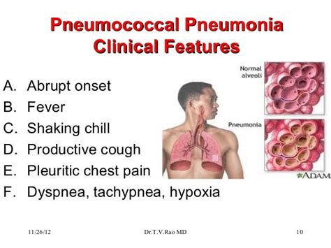 Streptococcus pneumoniae