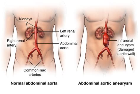 Abdominal Aortic Aneurysm | Living Smart | St. Joseph’s/Candler | St ...