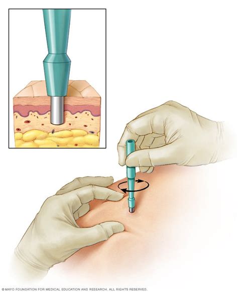 Biopsy: Types of biopsy procedures used to diagnose cancer - Drugs.com