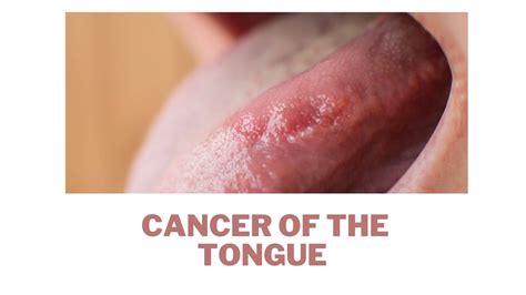 Tongue Cancer