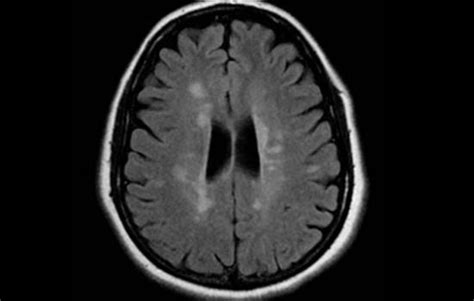 MS brain lesions: Pictures and prognosis