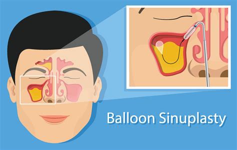 Balloon Sinuplasty - SinusHealth