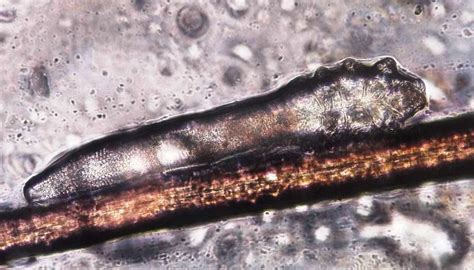 Demodex folliculorum: Causes, symptoms, and treatment