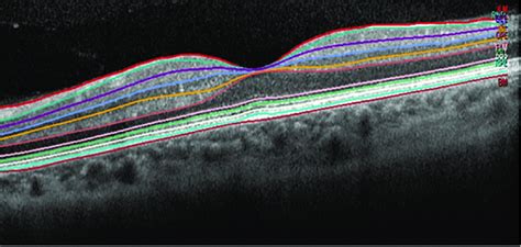 Segmentation of the retinal layers. Single horizontal foveal scans were ...