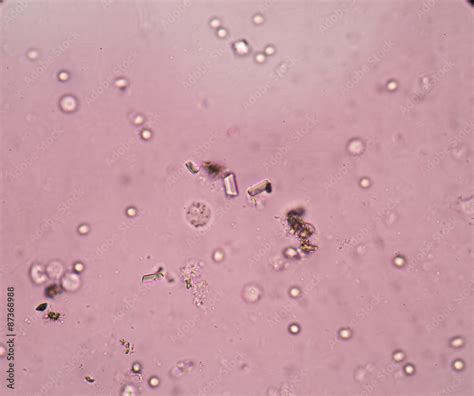 Triple Phosphate Crystals In Human Urine