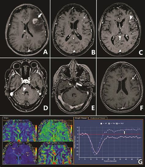 (A) Initial presentation of the enhancing lesion in the left frontal ...