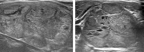 Diagnosis of Thyroid Nodules from Medical Ultrasound Images with Deep ...