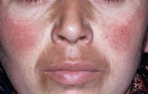 7 Melasma Treatments - How to Treat Brown Spots on Skin