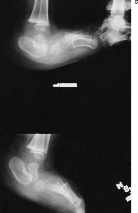 Congenital Vertical Talus - Pediatrics - Orthobullets