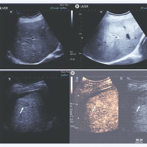 Ultrasound scan of a (A) normal liver, (B) liver with mild fat... | Download Scientific Diagram