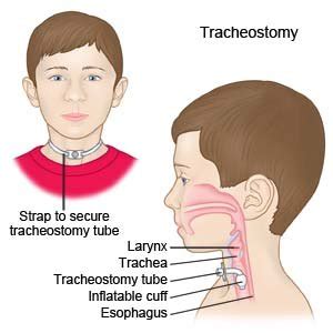 Tracheostomy Care Steps