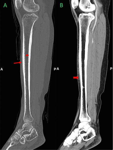 Osteomyelitis X Ray Features