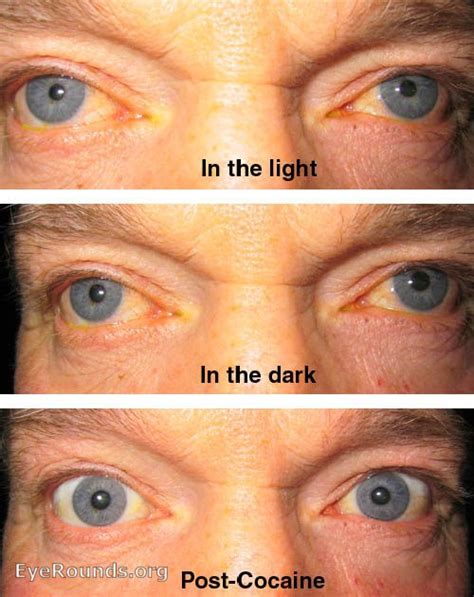 Atlas Entry - Physiologic anisocoria