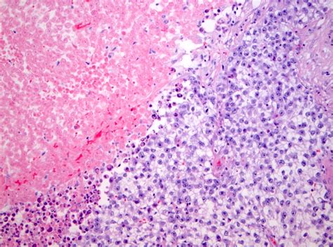 Pathology Outlines - Seminoma