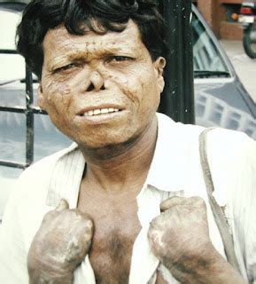 Leprosy in India and National Leprosy Eradication Programme - Seeker's ...