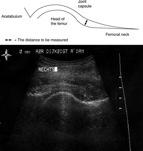 Sonography for hip joint effusion in adults with hip pain | Annals of ...